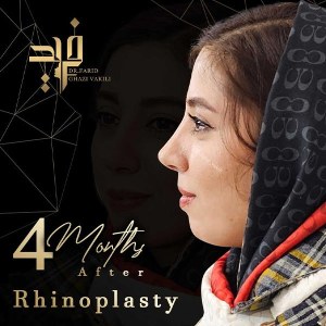 جراحی-بینی-5