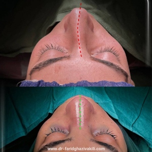 1_Rhinoplasty-56