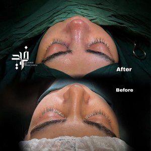 Rhinoplasty-39