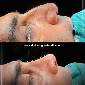 Rhinoplasty-40