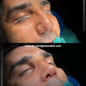 Rhinoplasty-41