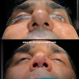 Rhinoplasty-42