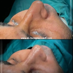 Rhinoplasty-43