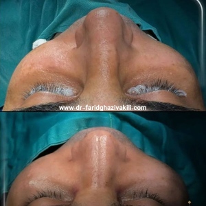 Rhinoplasty-44