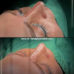 Rhinoplasty-45