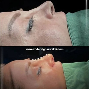 Rhinoplasty-46