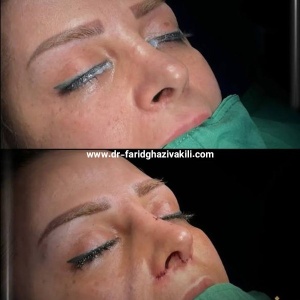 Rhinoplasty-47