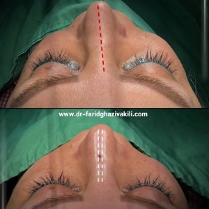 Rhinoplasty-48