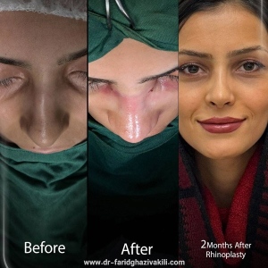 Rhinoplasty-49