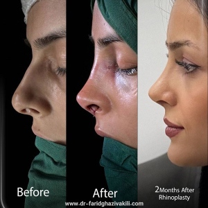 Rhinoplasty-50