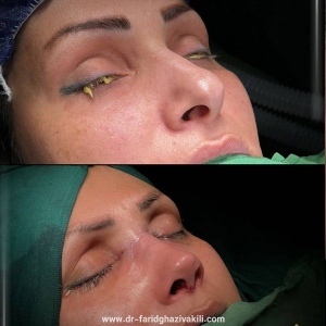 Rhinoplasty-51