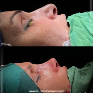 Rhinoplasty-52