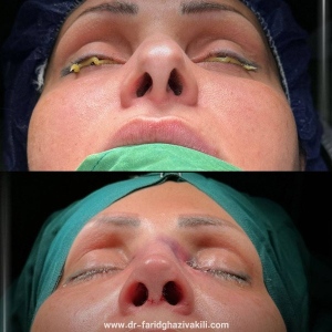 Rhinoplasty-53