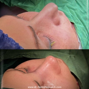 Rhinoplasty-54