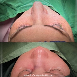 Rhinoplasty-55
