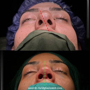 Rhinoplasty-57