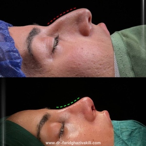 Rhinoplasty-58