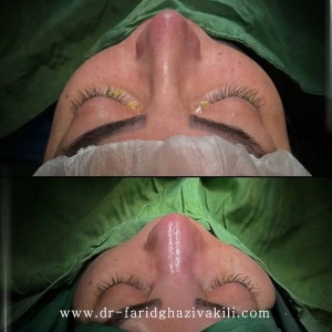 Rhinoplasty-77