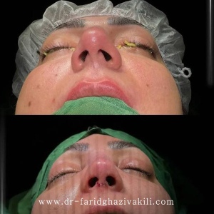 Rhinoplasty-78
