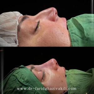Rhinoplasty-79