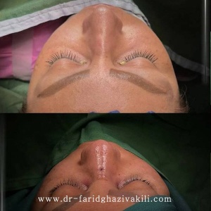Rhinoplasty-80
