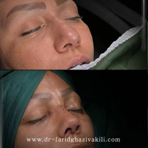 Rhinoplasty-81