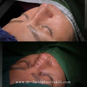 Rhinoplasty-82