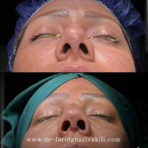 Rhinoplasty-83