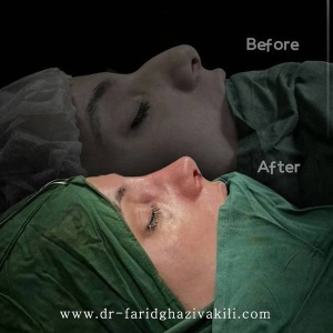 Rhinoplasty-84