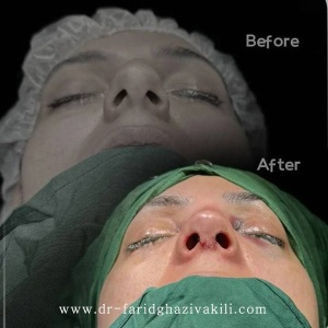 Rhinoplasty-85