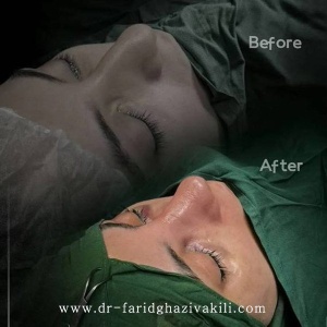 Rhinoplasty-86