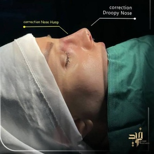Rhinoplasty67