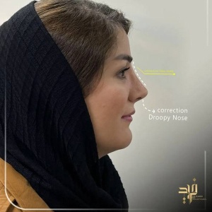 Rhinoplasty68