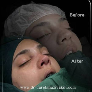 Rhinoplasty69