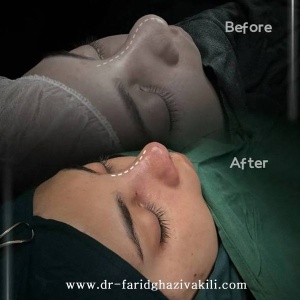 Rhinoplasty70