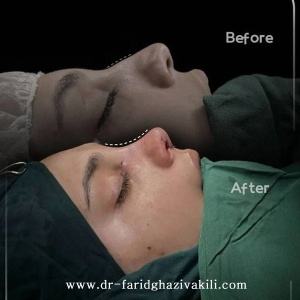 Rhinoplasty71