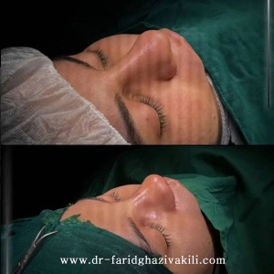 Rhinoplasty72