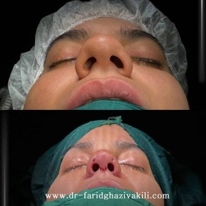 Rhinoplasty73