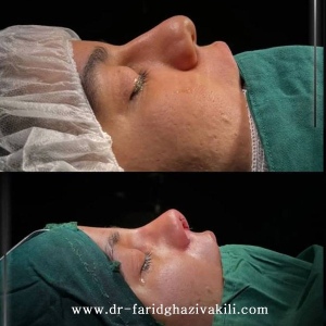 Rhinoplasty74
