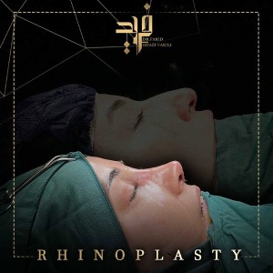 rhinoplasty-12