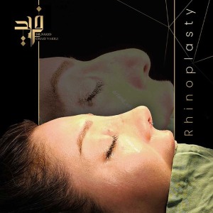 rhinoplasty-13