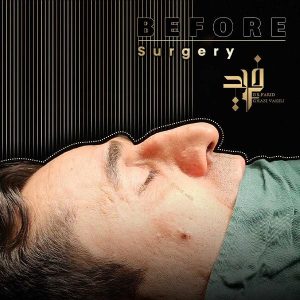 rhinoplasty-14