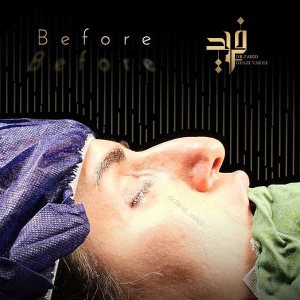 rhinoplasty-15