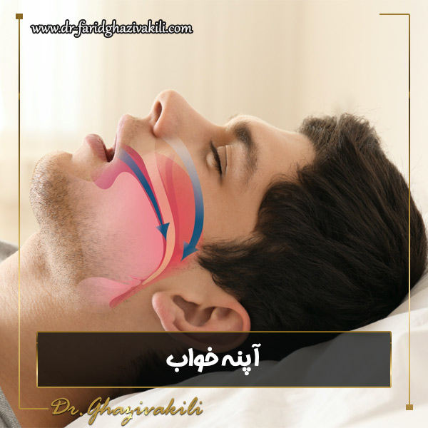 آپنه خواب و راه های درمان آن -دکتر فرید قاضی وکیلی