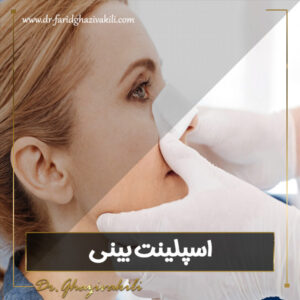 اسپلینت بینی - https://dr-faridghazivakili.com/