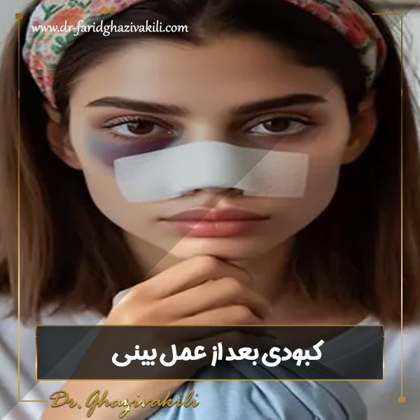 کبودی بعد از عمل بینی - دکتر فرید قاضی وکیلی -dr-faridghazivakili.com