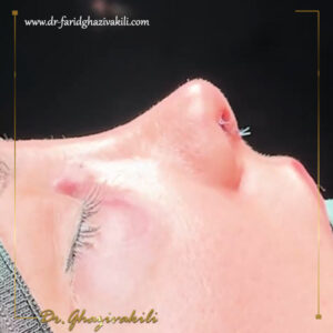 عکس نمونه کار جراحی بینی فانتزی - دکتر فرید قاضی وکیلی - dr-faridghazivakili.com