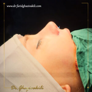 عکس نمونه کار عمل بینی فانتزی - دکتر وکیلی - dr-faridghazivakili.com