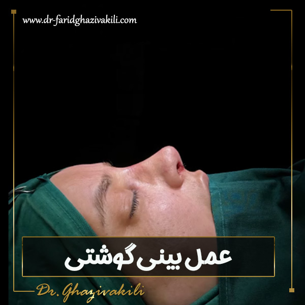 عمل بینی گوشتی - دکتر فرید قاضی وکیلی -dr-faridghazivakili.com