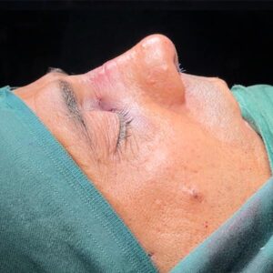 عکس بلافاصله بعد از عمل جراحی بینی استخوانی - دکتر قاضی وکیلی - dr-faridghazivakili.com